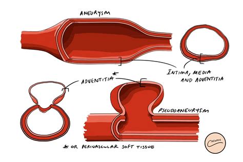 pseudoaneurysm vs aneurysm ultrasound.